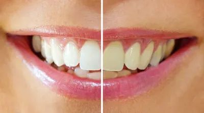 Dr. Jack Wolf offers an affordable professional strength teeth whitening system for dramatic results