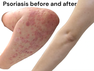 Arm with psoriasis before and after treatment.