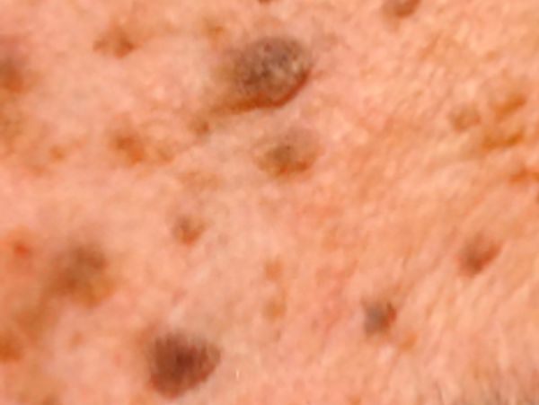 Close-up of skin with multiple dark spots and moles.