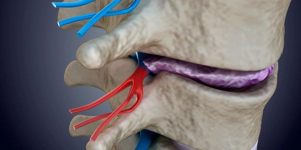pinched nerve with a disc injury 