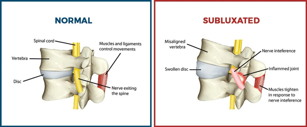 A visual example of a subluxation.