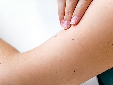 Skin Check and skin cancer and rash evaluation