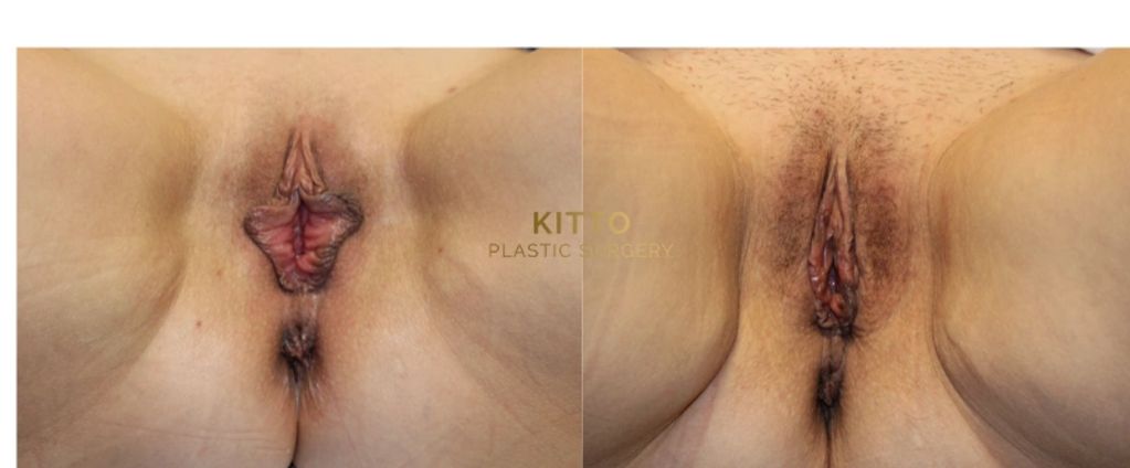 Close-up view of labiaplasty outcomes, demonstrating functional and aesthetic improvements.