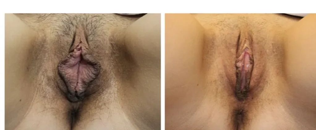 Results of a successful labiaplasty surgery, showcasing increased comfort and self-assurance.