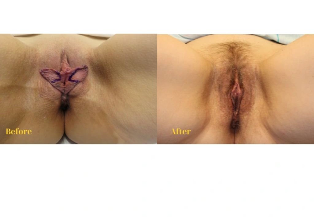 Results of labiaplasty surgery highlighting enhanced comfort and aesthetic refinement.