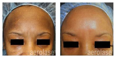 melasma and hyperpigmentation treatment in kailua-kona hawaii
