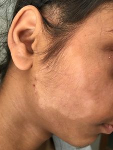Tinea facei
Fungal infection of Face