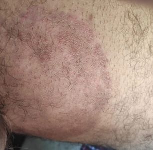 FunGal Infection in groin area
Area of inner thigh