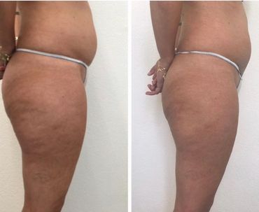 Reducing water retention around the tummy and hip area, resulting in weight loss and smoother skin.