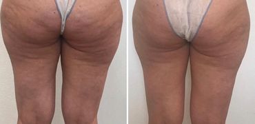 Firmer skin and smoother apprearance with reduced inch loss.