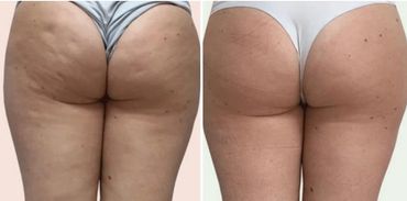Cellulite reduction and smoother skin provided by Lymphatic Drianage Compression Massage Therapy