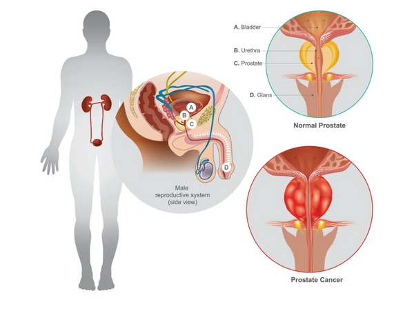 The Prostate cancer is the most common cancer among men not skin cancer. The Prostate cancer that st
