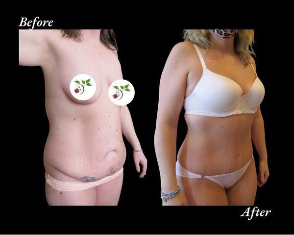 Tedesco, cosmetic surgery, plastic, lipo, liposuction, tummy, removal, Tulsa, Bixby, surgeon, John