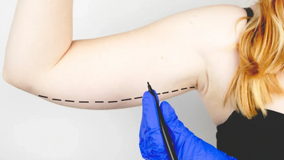Tedesco, cosmetic surgery, plastic, lipo, liposuction,  arm skin, removal, Tulsa, Bixby, surgeon,