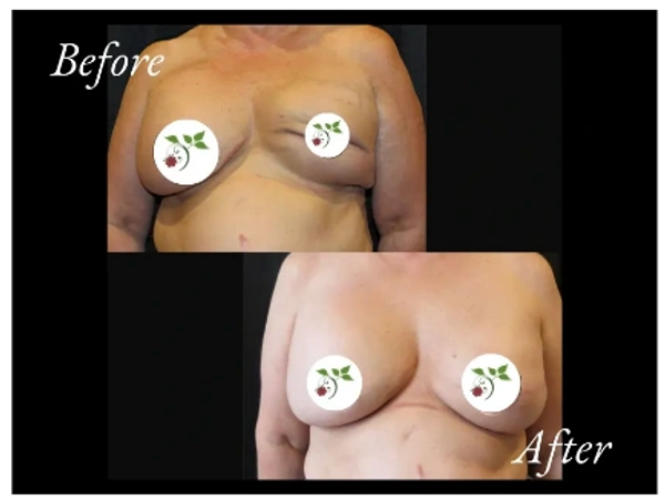 breast cancer, tedesco, cosmetic surgery, reconstruction, breast, tulsa, Mastectomy