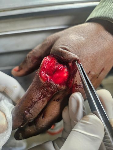 A severe open wound on a person's finger being treated with medical tools.