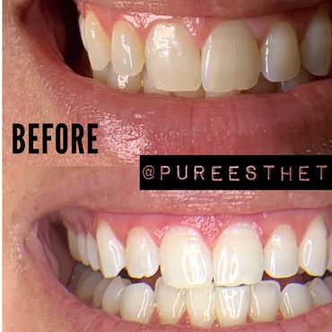 Before and After Smile Labs Cosmetic Teeth Whitening System.