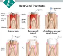 Root Canals, Root Canals in Kokomo, Quality Root Canals, Painless Root Canals, dentist, dental, dds