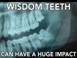 Wisdom Teeth Extraction, Painless Wisdom Teeth, Tooth Pull, Wisdom Tooth, Impacted Wisdom Teeth, dds