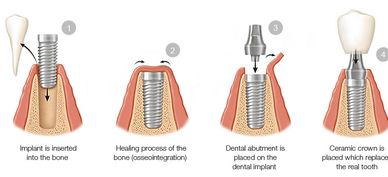 Dental Implants, dental implant specialist, affordable dental implants, quality dental implants, dds