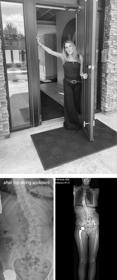 Colleen Knorek standing at the door to her pilates classes with scoliosis X-rays below