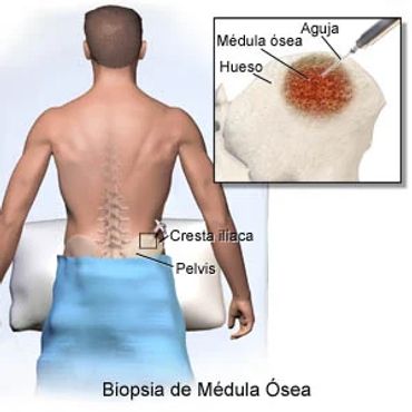 Aspirado y biopsia de medula osea