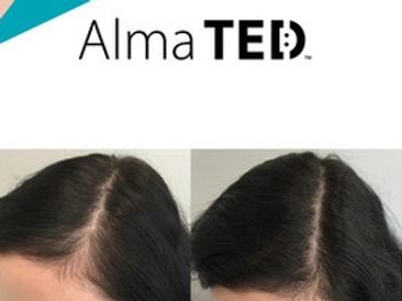 Hair Restoration for male pattern baldness, covid hair loss, female hair loss effective!