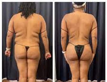 Beautifill laser liposuction with or without fat transplant to BBL or Breast Augmentation