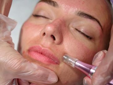 Vampire facial, P R P microneedling, RF microneedling
