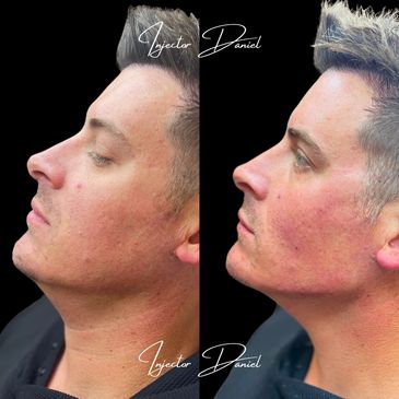 jawline filler for men ha fillers for men mens skin rejuvenation facial masculinization with filler