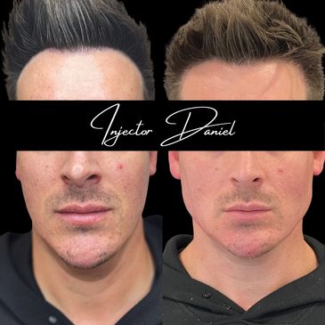 jawline filler for men ha fillers for men mens skin rejuvenation facial masculinization with filler