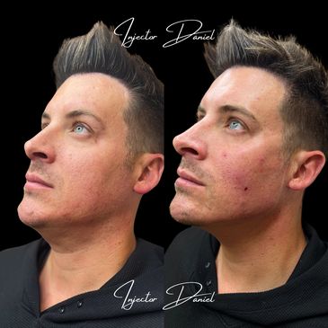 jawline filler for men ha fillers for men mens skin rejuvenation facial masculinization with filler