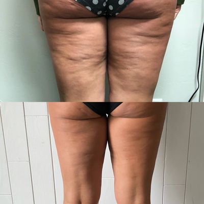 Cellulite reduction, Cellulite removal, Fat freezing, Cool Sculpting, Laser lipo, lipo suction