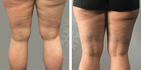 Cellulite reduction, Cellulite removal, Fat freezing, Cool Sculpting, Laser lipo, lipo suction