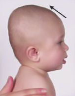 Deformasyonel Brakisefali Yandan bakıldığında