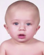 Deformasyonel Brakisefali Önden