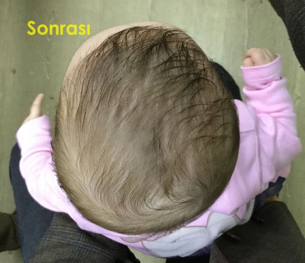 Plajiosefali Sonrası