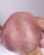 Deformasyonel Brakisefali