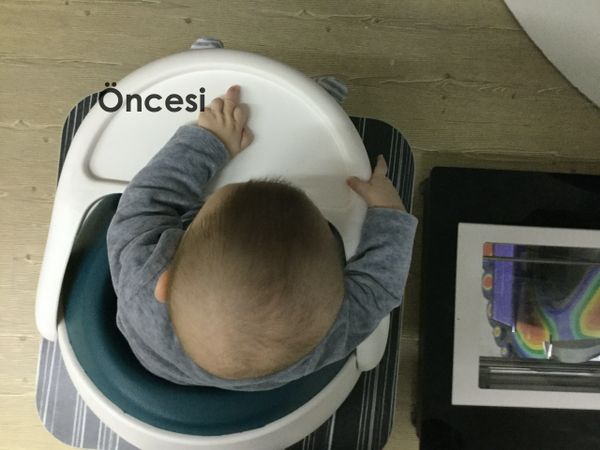 Pozisyonel Plajiosefali Öncesi