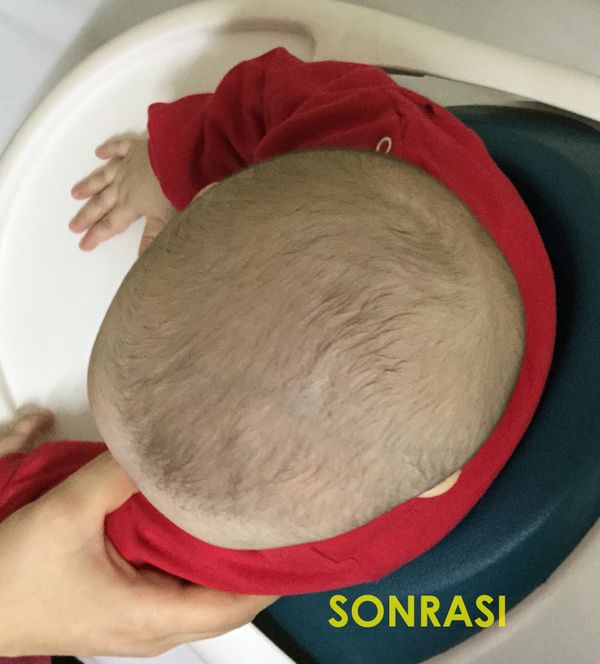 Skafosefali Sonrası