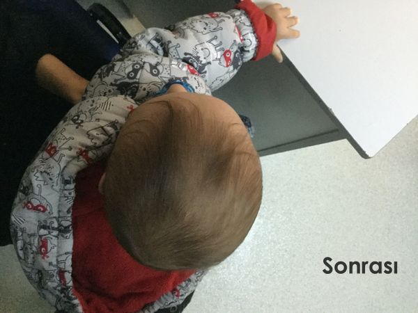 Pozisyonel Plajiosefali Sonrası