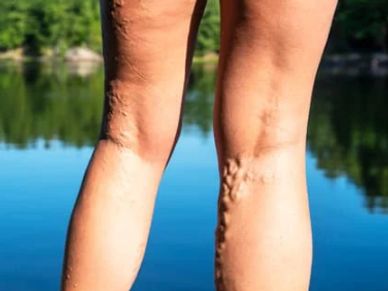 Varicose Veins on the backs of legs