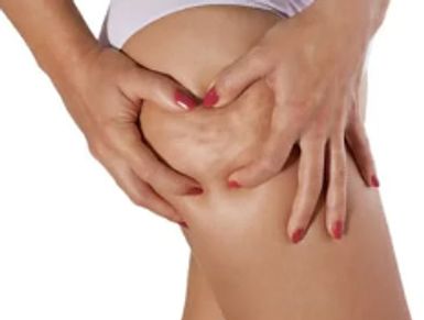 Cellulite on top of thigh