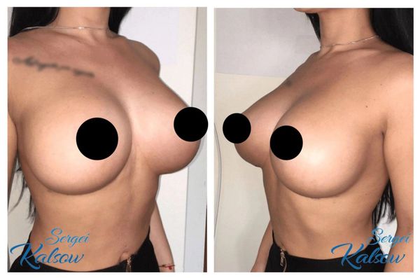 Breast augmentation, 450cc silicone smooth round implants, placed under the muscle VIA IMF incision.