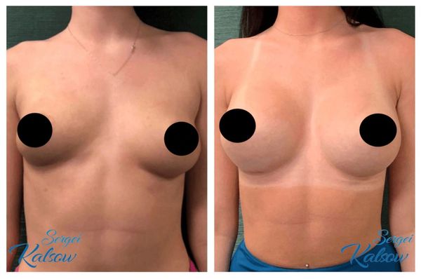Breast augmentation, 375cc silicone smooth round implants, placed under the muscle VIA IMF incision.
