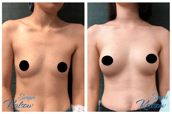 Breast augmentation, 250cc silicone smooth round implants, placed under the muscle VIA IMF incision.