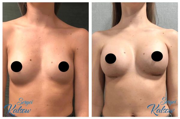 Breast augmentation, 200cc silicone smooth round implants, placed under the muscle VIA IMF incision.