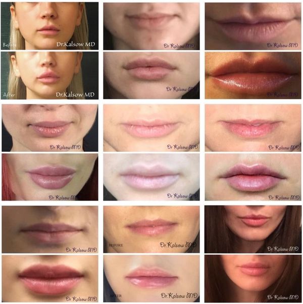 Compilation of lip filler before and afters by Dr.Kalsow.