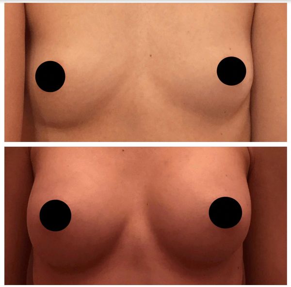 Breast augmentation, 350cc silicone smooth round implants, placed under the muscle VIA IMF incision.