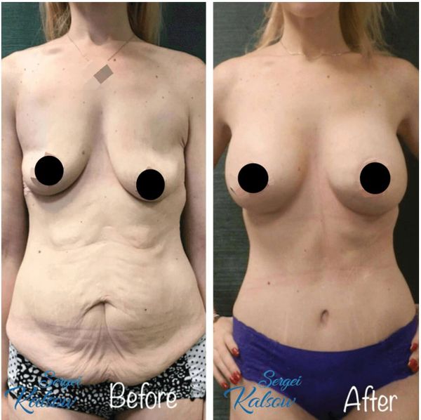 Body contouring after bariatric surgery - tummy tuck, and breast lift with implants.